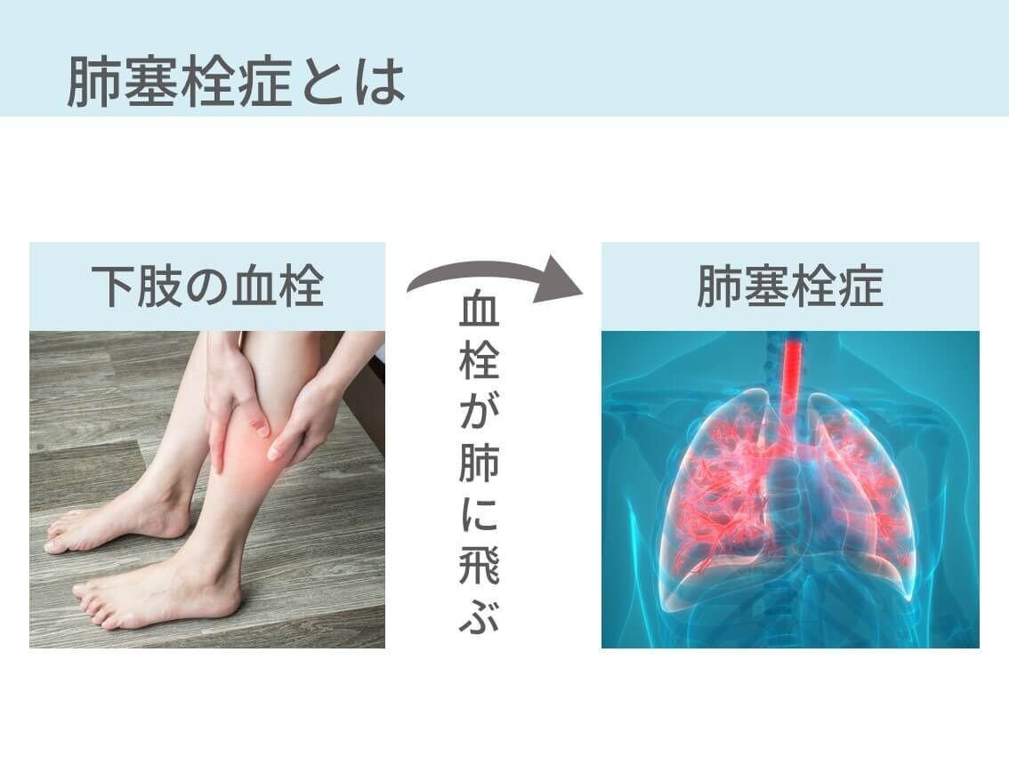 肺 塞栓 症 と は